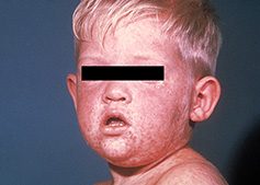 a child with the measles rash all over their face