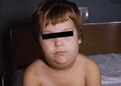 a child with mumps on their face