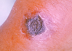 Anthrax - image of a dark pigmented skin patch