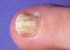 fungal infection on the toe nail