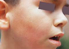 a rash from parvovirus on the cheek of a young boys face